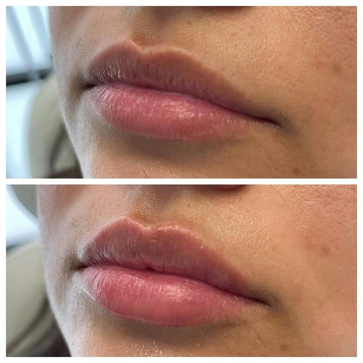 Petite Pout® Before & After Gallery - Patient 103996889 - Image 1