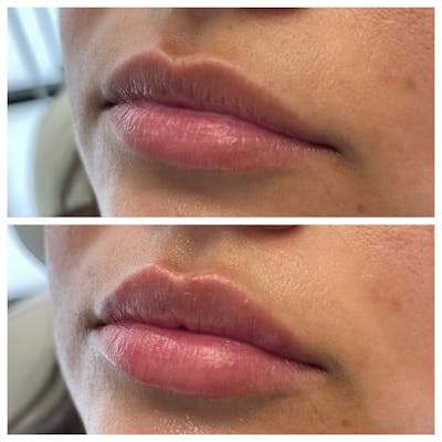 Petite Pout® Before & After Gallery - Patient 103996889 - Image 1