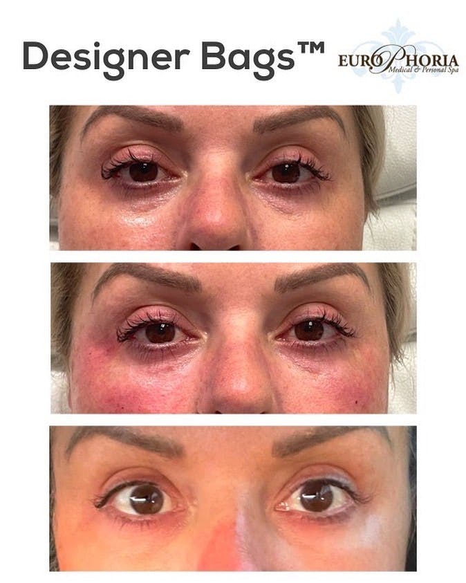 Designer Bags™ Before & After Gallery - Patient 104019941 - Image 1