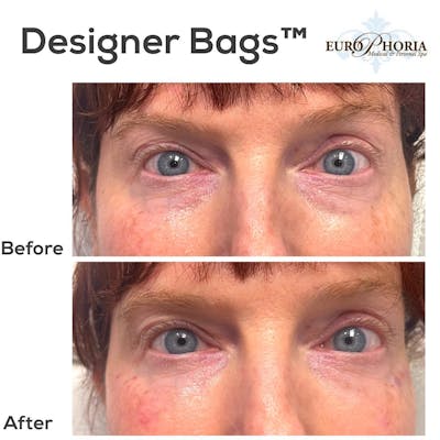 Designer Bags™ Before & After Gallery - Patient 104026912 - Image 1