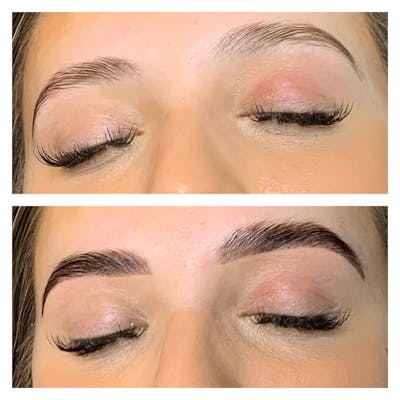 Brow Treatments Before & After Gallery - Patient 113533820 - Image 1