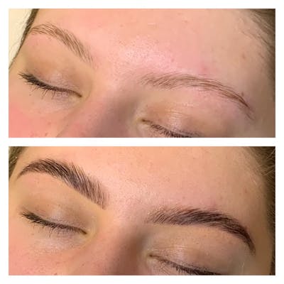 Brow Treatments Gallery - Patient 113533821 - Image 1