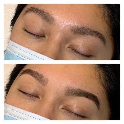 Brow Treatments Before & After Gallery - Patient 113533822 - Image 1