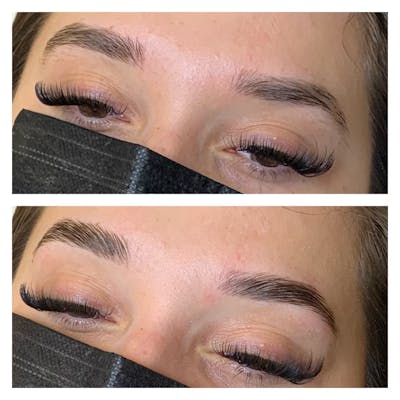 Brow Treatments Before & After Gallery - Patient 113533823 - Image 1