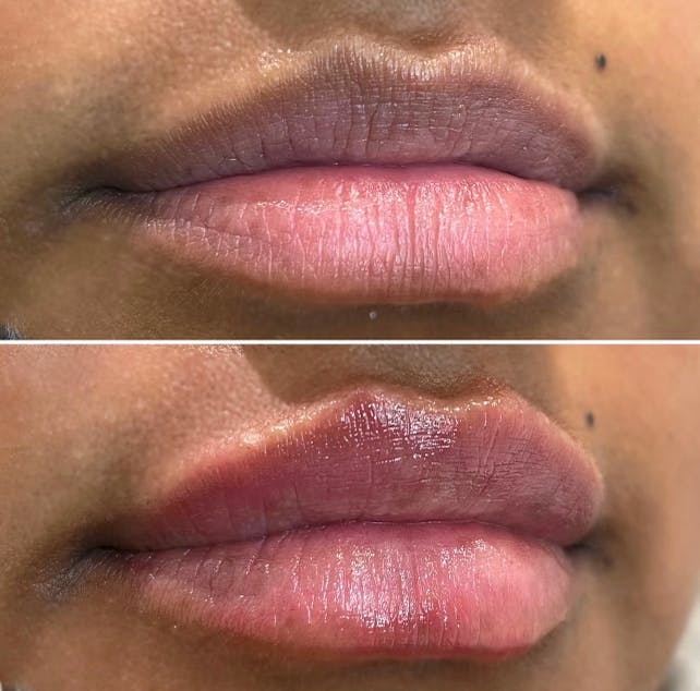 Full Pout® Before & After Gallery - Patient 113533851 - Image 1