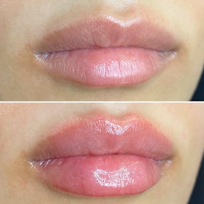 Full Pout® Before & After Gallery - Patient 113533850 - Image 1