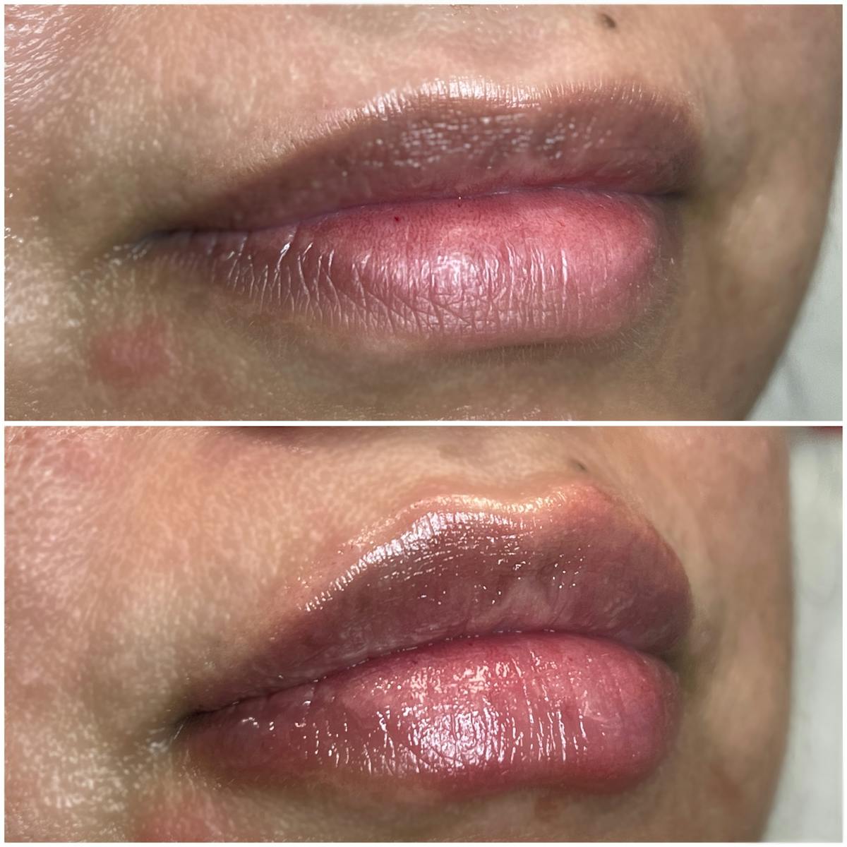 Full Pout® Before & After Gallery - Patient 113533852 - Image 1