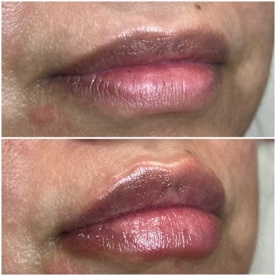 Full Pout® Before & After Gallery - Patient 113533852 - Image 1