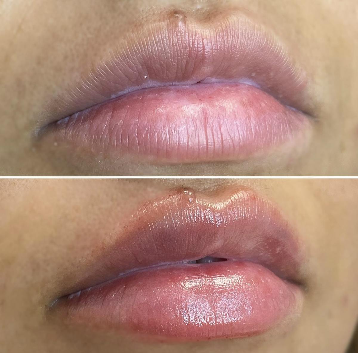 Petite Pout® Before & After Gallery - Patient 113533871 - Image 1