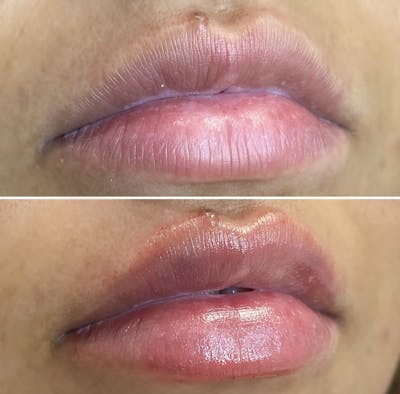 Petite Pout® Before & After Gallery - Patient 113533871 - Image 1