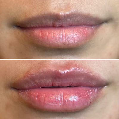 Petite Pout® Before & After Gallery - Patient 113533872 - Image 1
