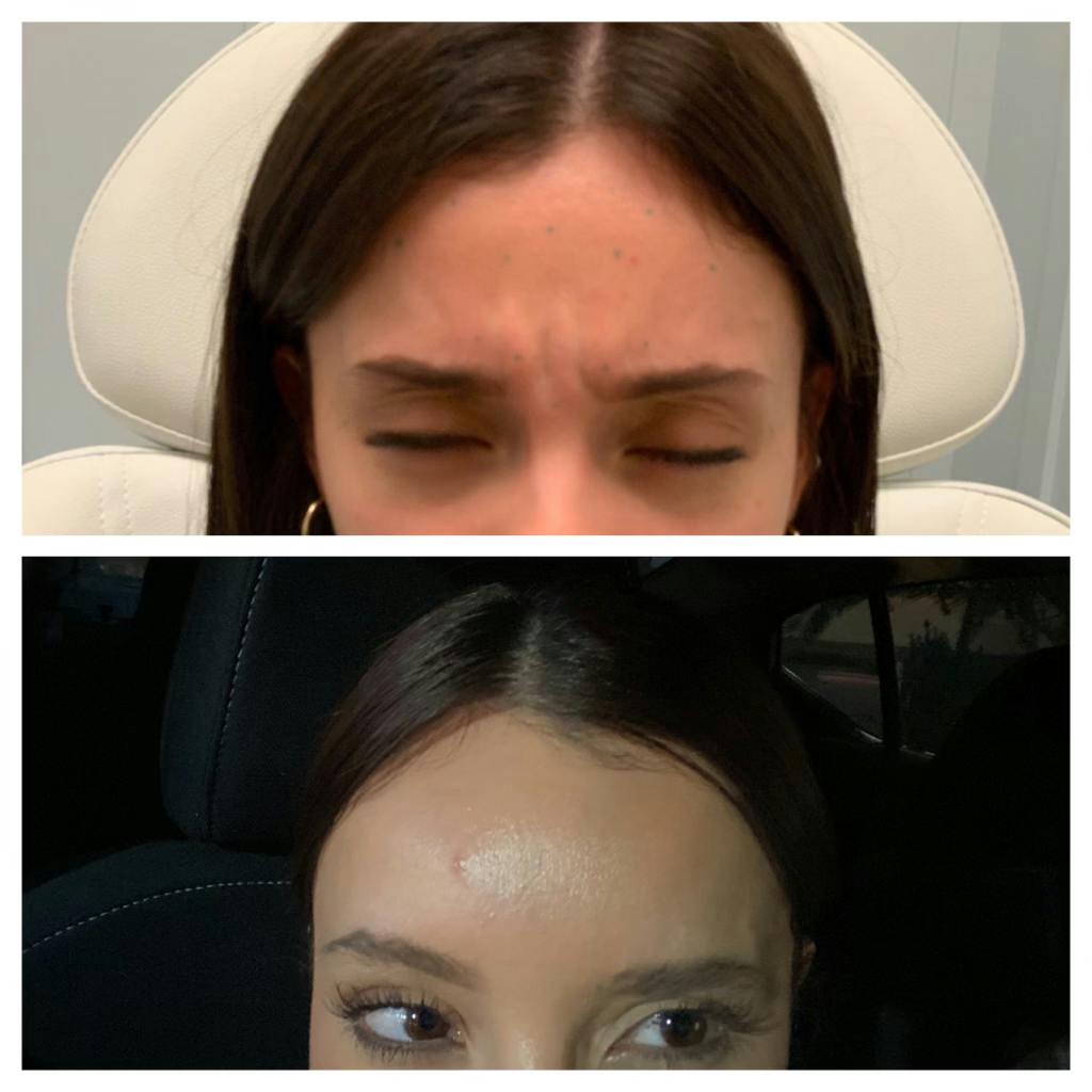 Wrinkle Relaxers Before & After Gallery - Patient 113533884 - Image 2