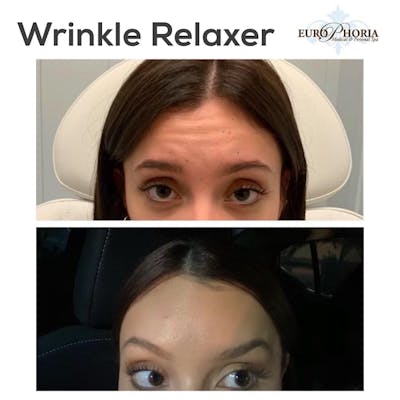 Wrinkle Relaxers Before & After Gallery - Patient 113533884 - Image 1