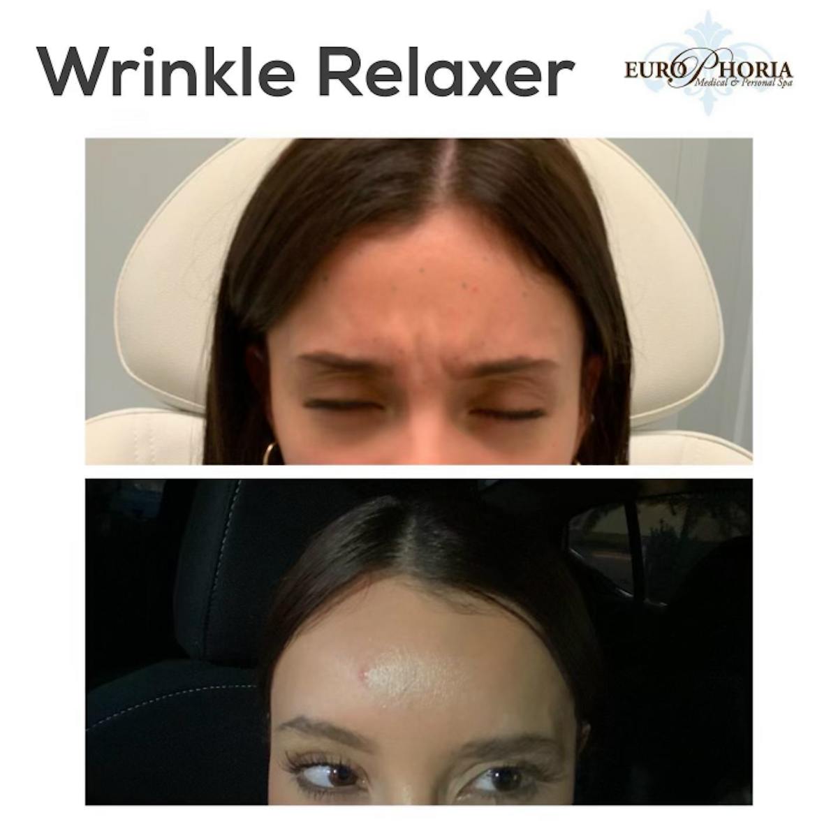 Wrinkle Relaxers Before & After Gallery - Patient 113533884 - Image 4
