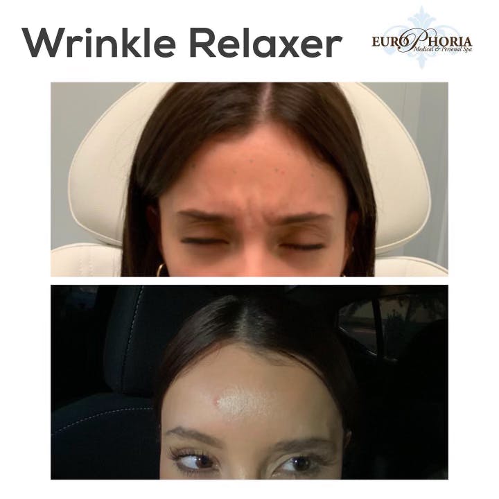 Wrinkle Relaxers Gallery - Patient 113533884 - Image 4