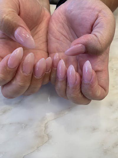 Signature Nail Treatments Before & After Gallery - Patient 113537064 - Image 1