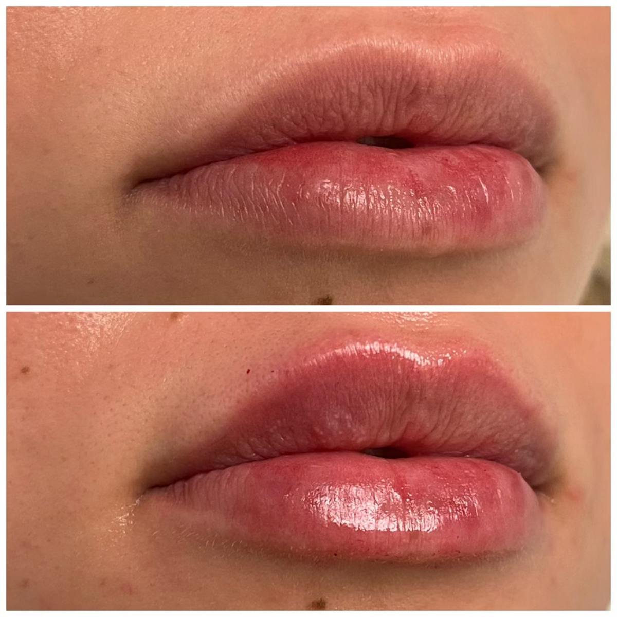 Petite Pout® Before & After Gallery - Patient 115017206 - Image 1