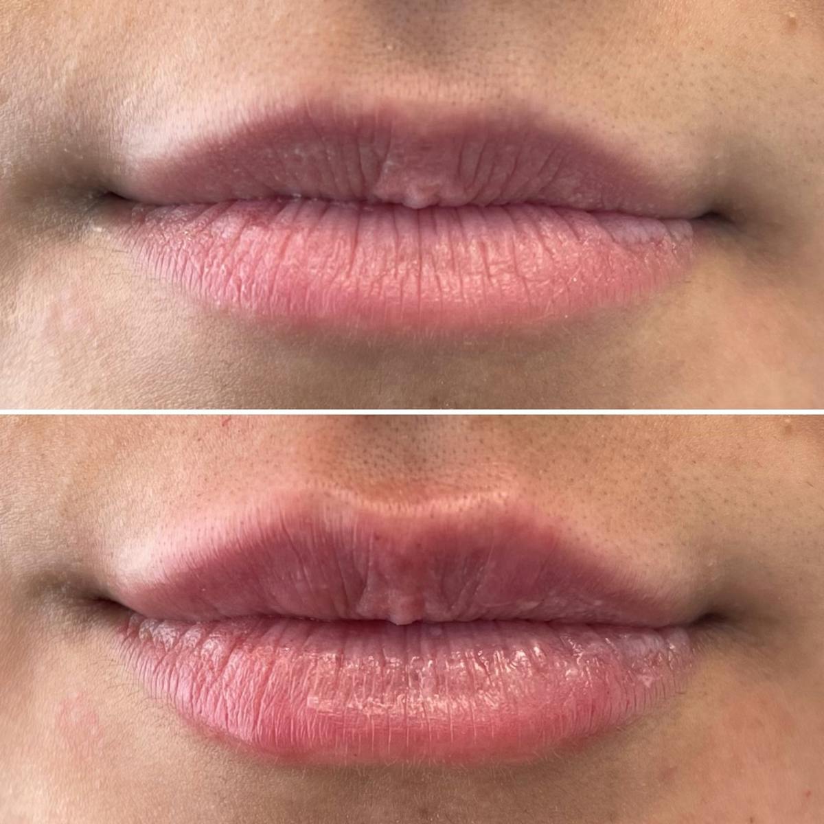 Petite Pout® Before & After Gallery - Patient 115017207 - Image 1
