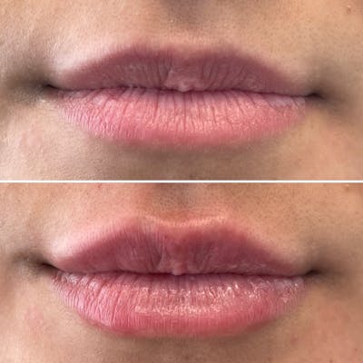 Petite Pout® Before & After Gallery - Patient 115017207 - Image 1