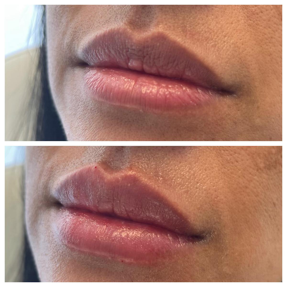 Petite Pout® Before & After Gallery - Patient 115017207 - Image 2