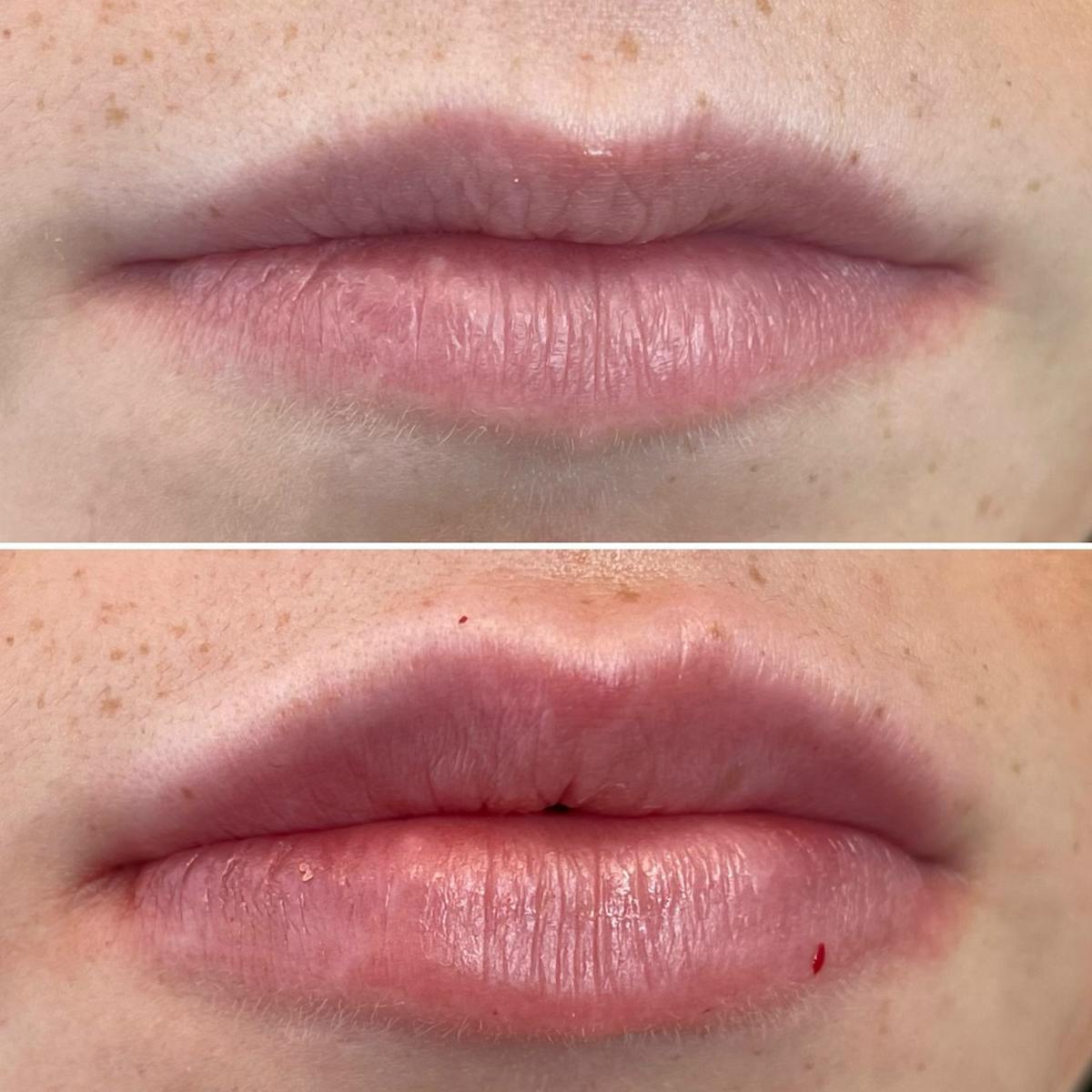 Full Pout® Before & After Gallery - Patient 115017262 - Image 1