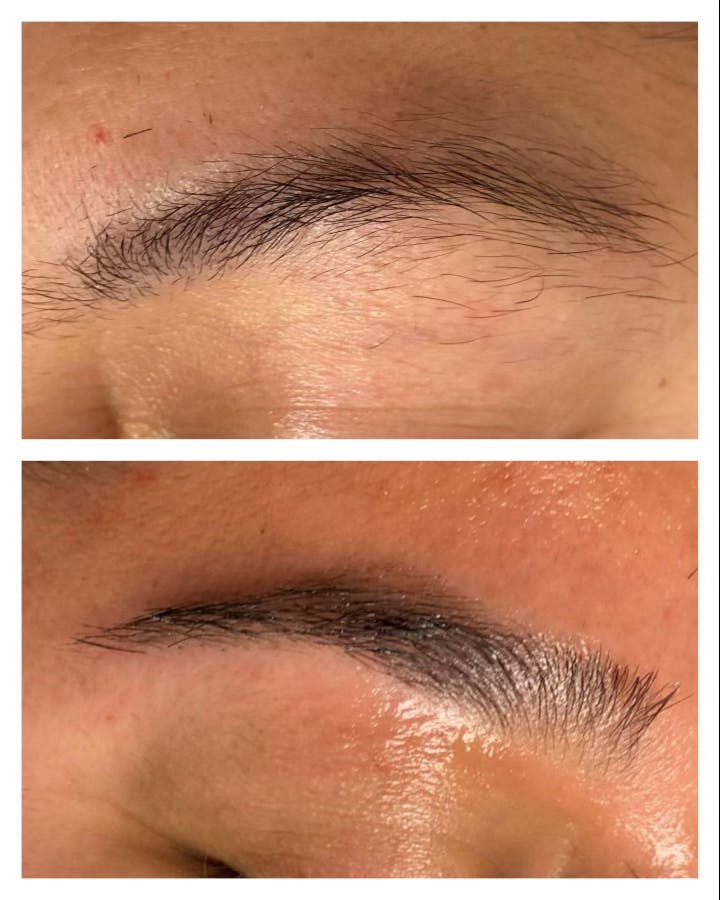 Brow Treatments Before & After Gallery - Patient 118556291 - Image 1