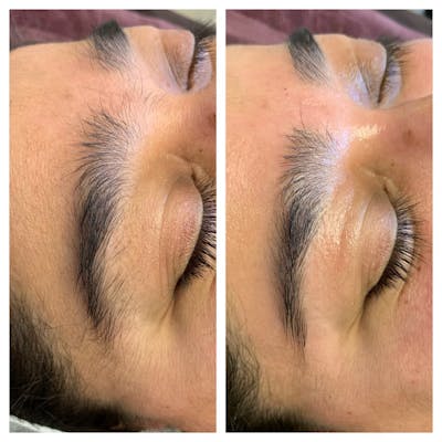 Brow Treatments Before & After Gallery - Patient 118556293 - Image 1