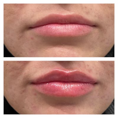 Petite Pout® Before & After Gallery - Patient 120734446 - Image 1