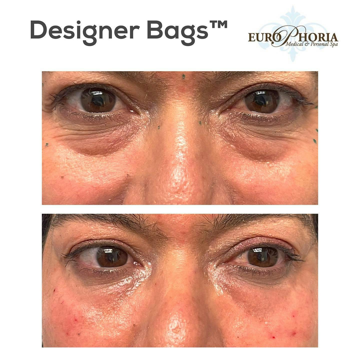 Designer Bags™ Before & After Gallery - Patient 120734603 - Image 1