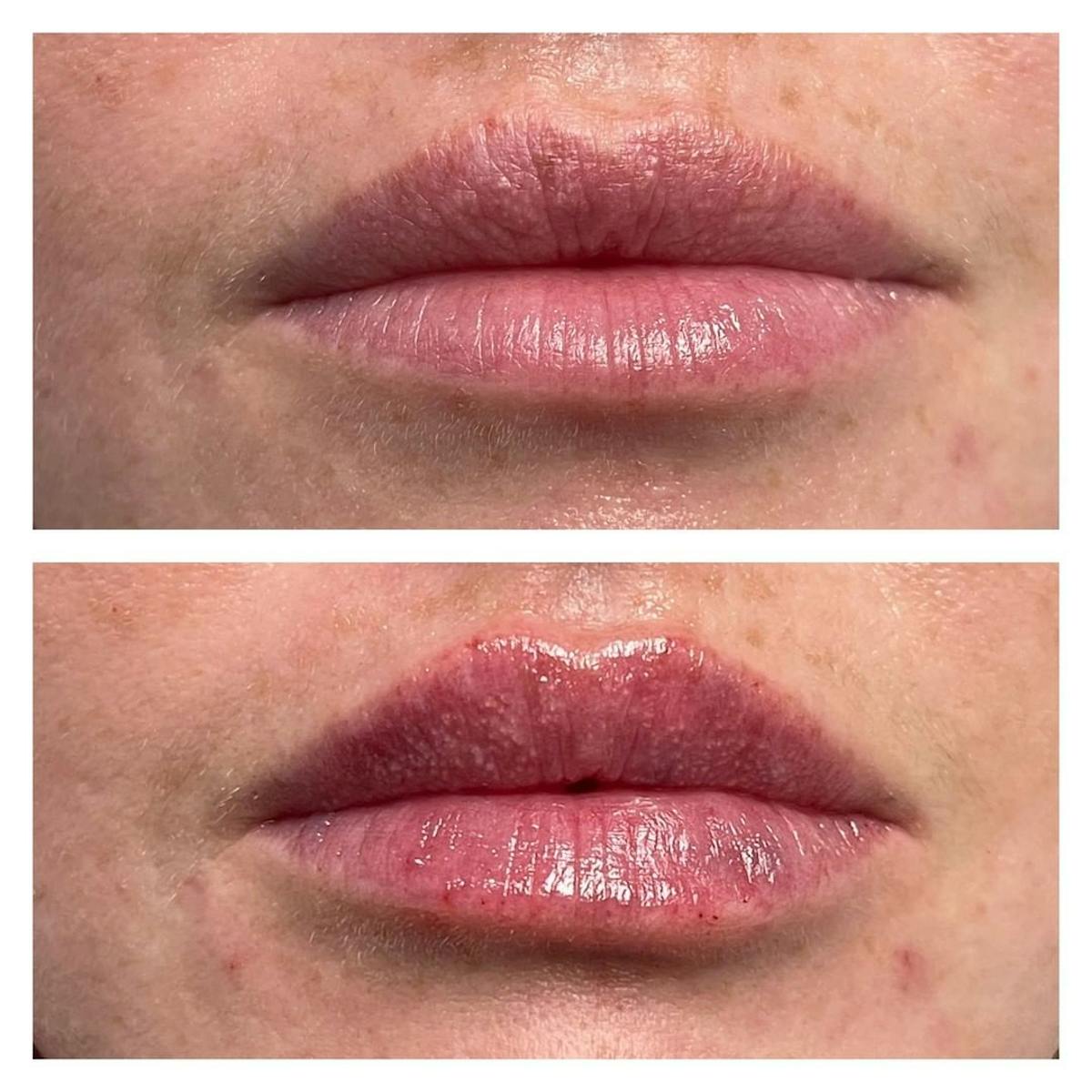 Full Pout® Before & After Gallery - Patient 120735532 - Image 1