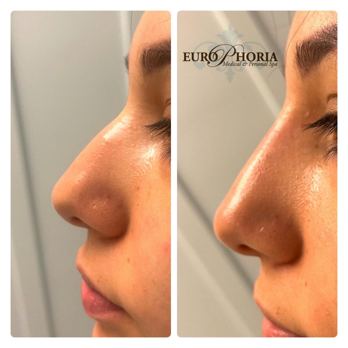 Non-Surgical Rhinoplasty Before & After Gallery - Patient 122582848 - Image 1