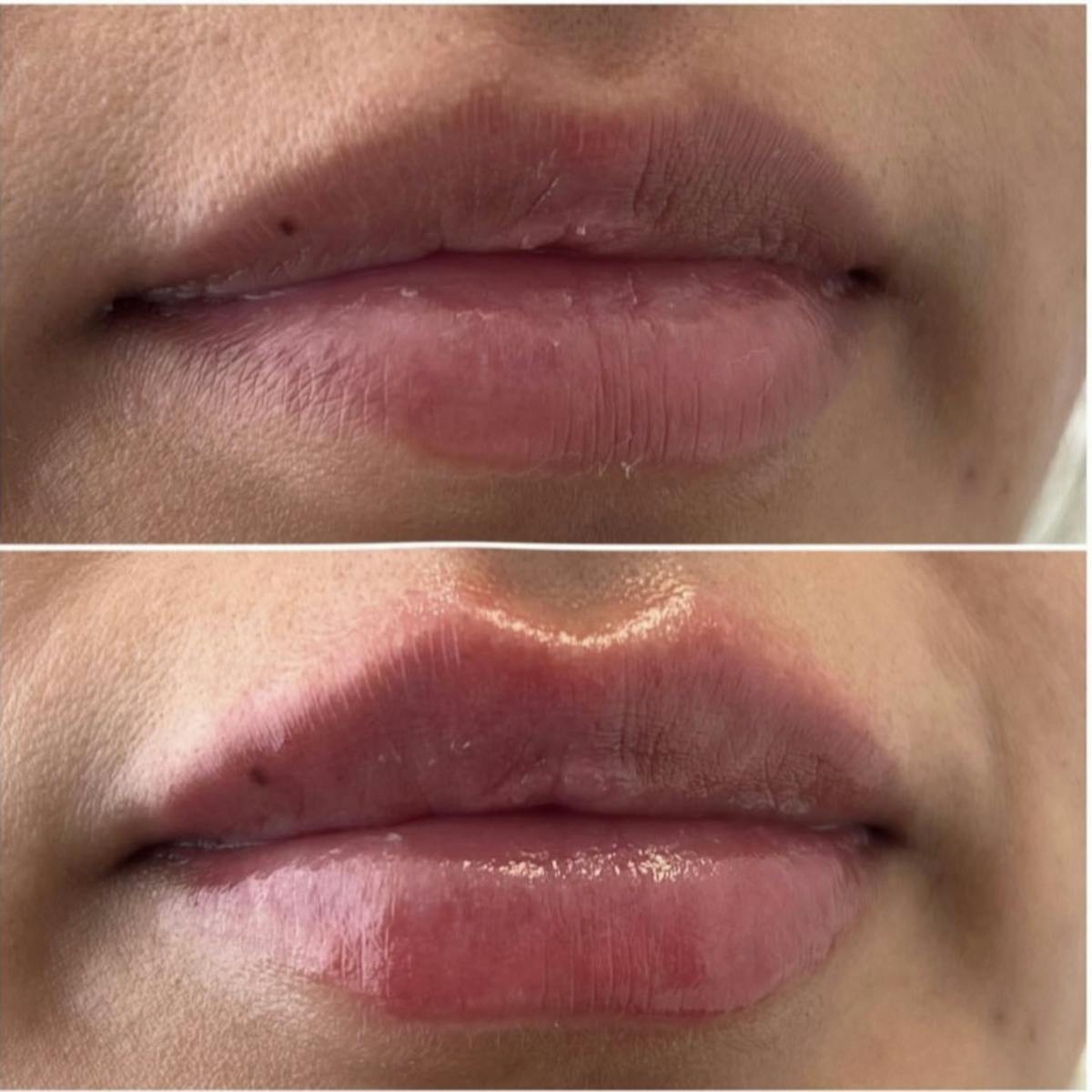Petite Pout® Before & After Gallery - Patient 122270710 - Image 1