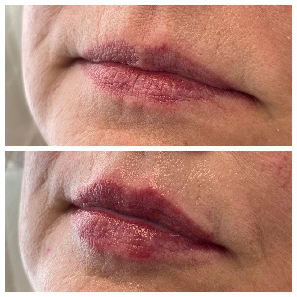 Petite Pout® Before & After Gallery - Patient 122270711 - Image 1