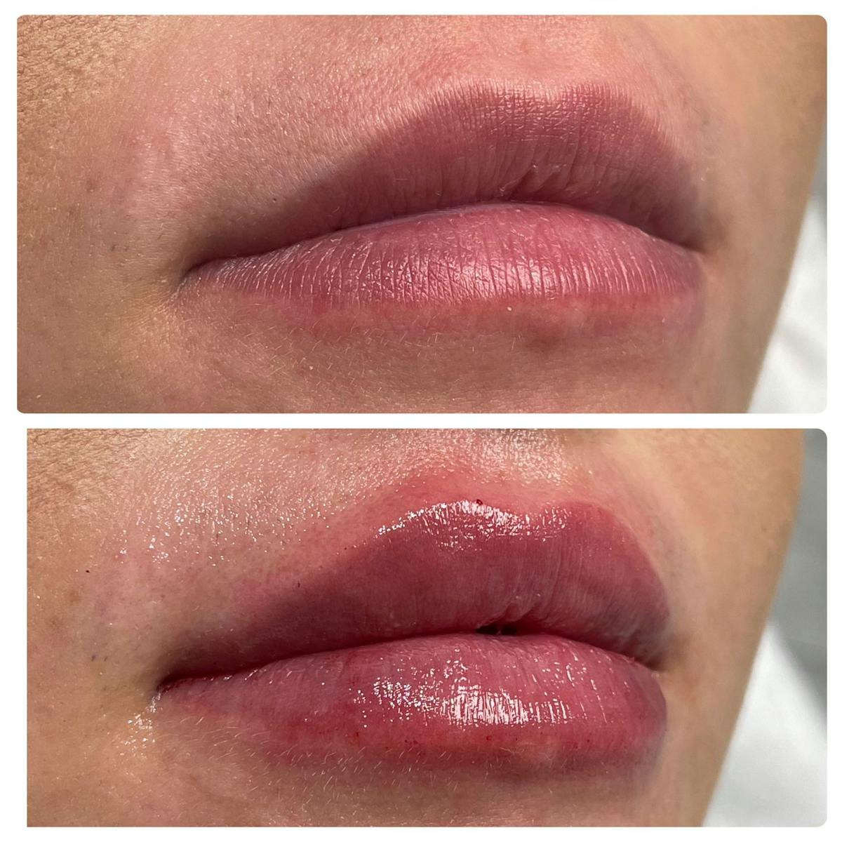 Petite Pout® Before & After Gallery - Patient 122270708 - Image 1