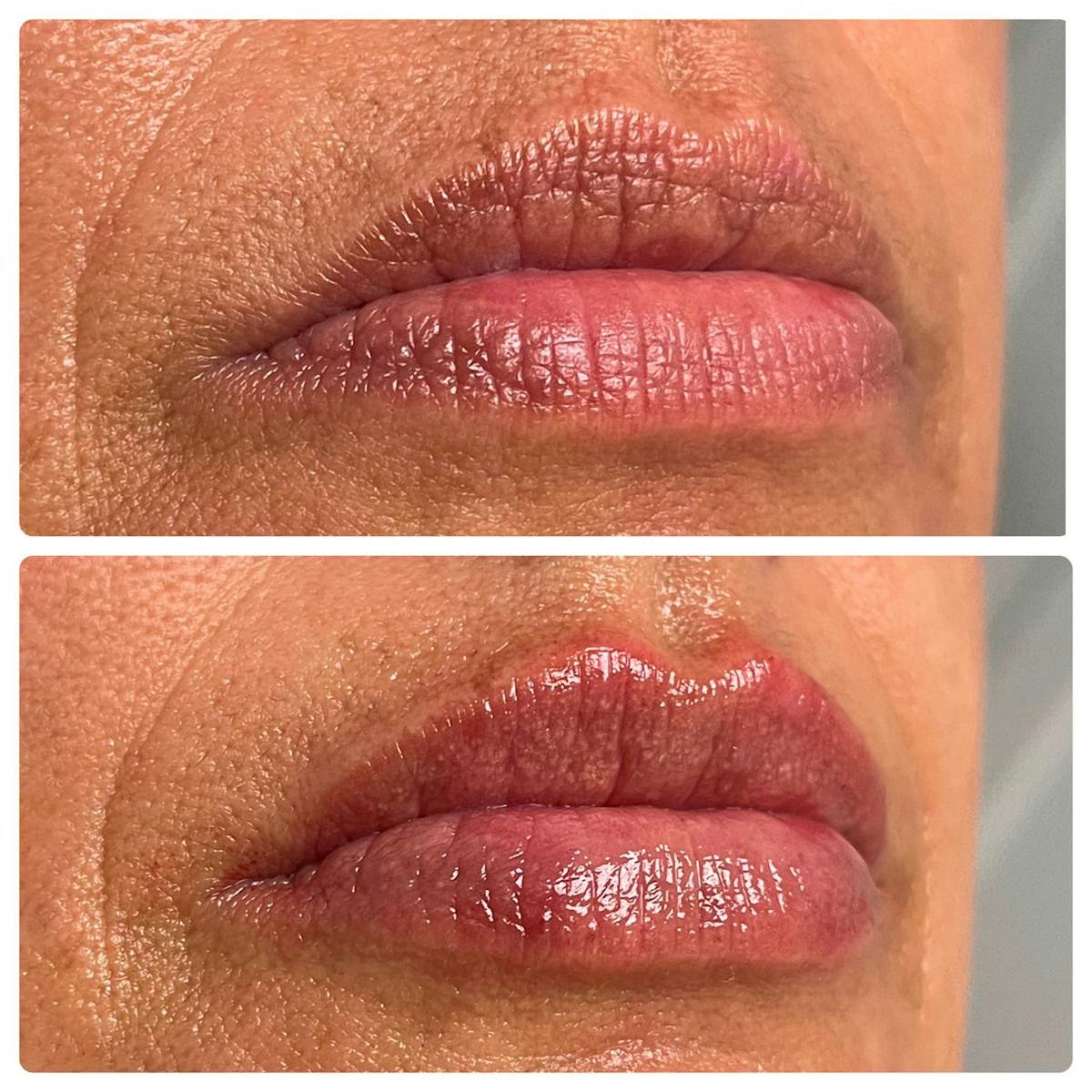 Petite Pout® Before & After Gallery - Patient 122270709 - Image 1