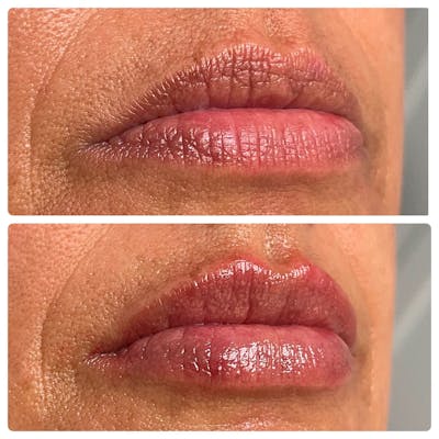 Petite Pout® Before & After Gallery - Patient 122270709 - Image 1