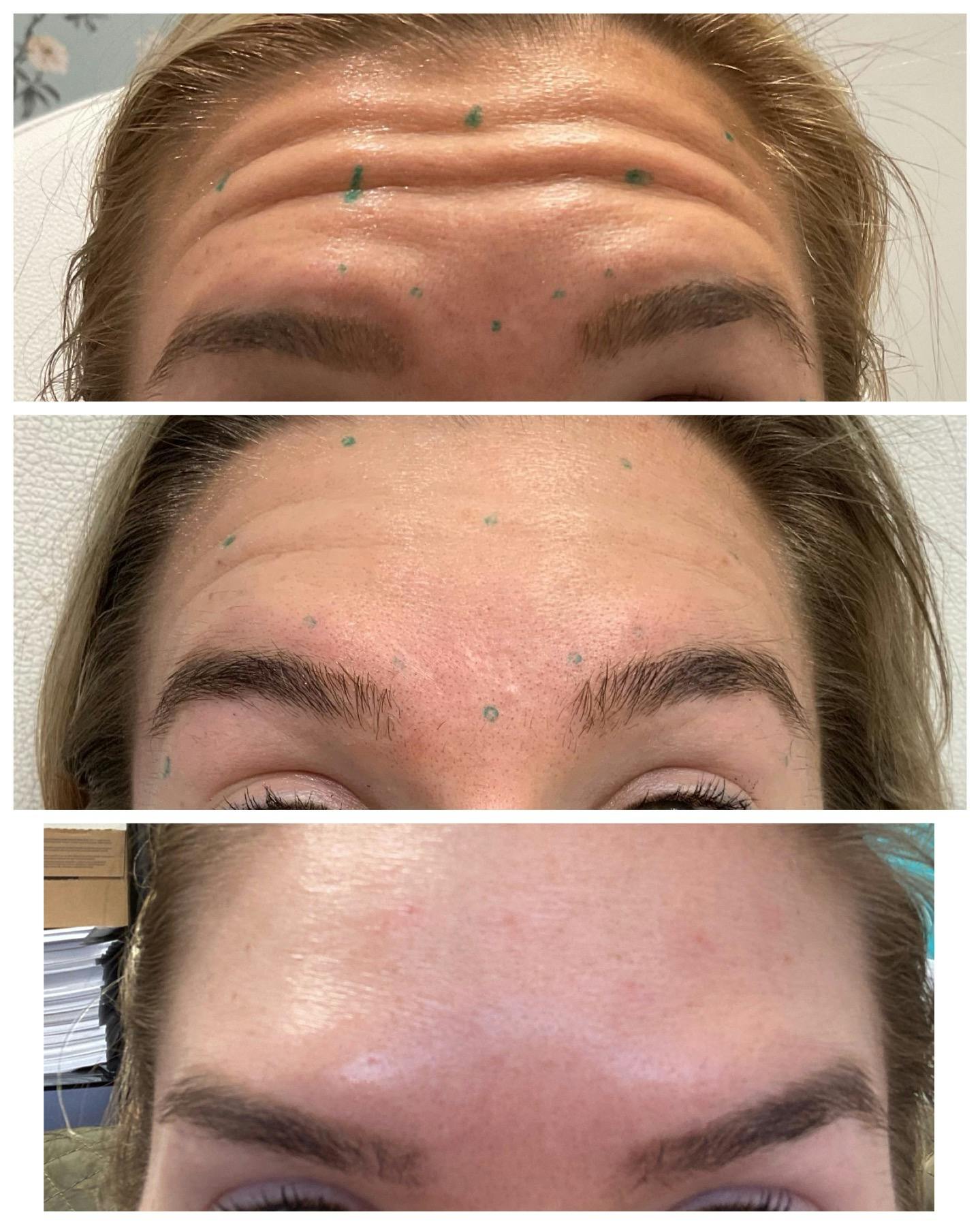 Wrinkle Relaxers Before & After Gallery - Patient 122270734 - Image 1