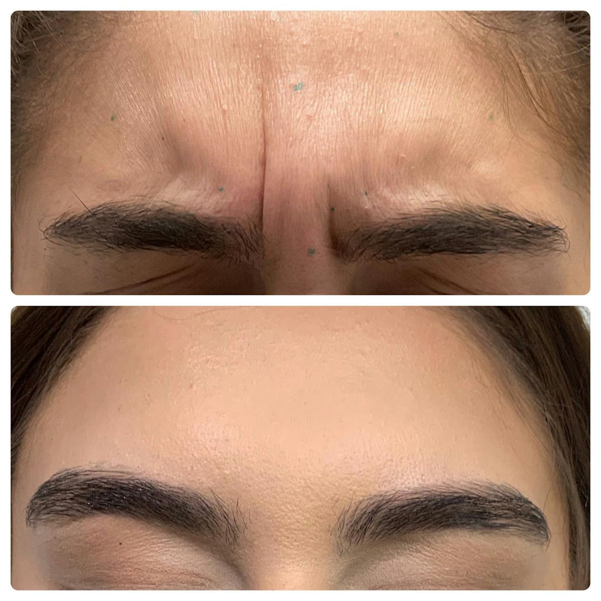 Wrinkle Relaxers Before & After Gallery - Patient 122270736 - Image 1