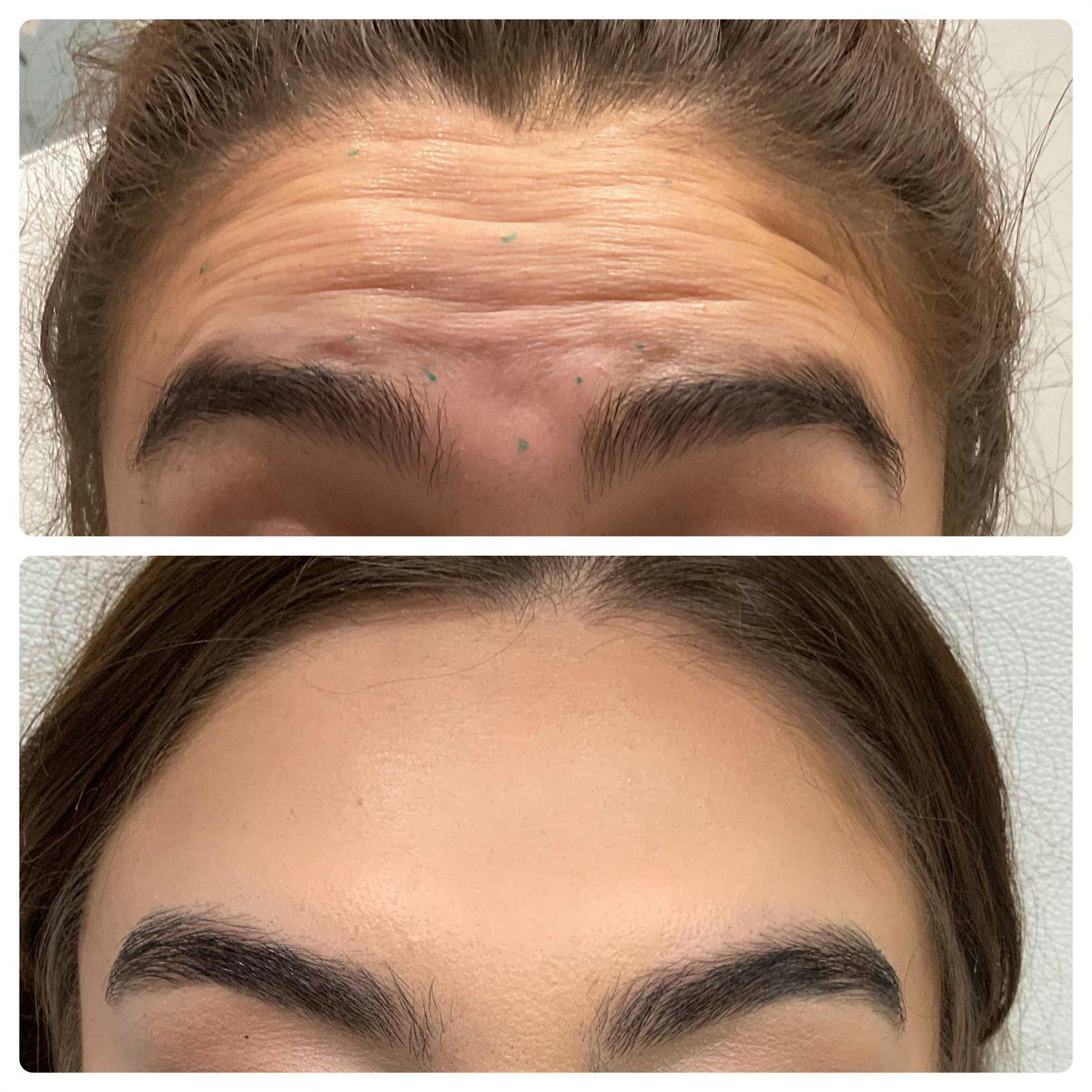 Wrinkle Relaxers Before & After Gallery - Patient 122270735 - Image 1
