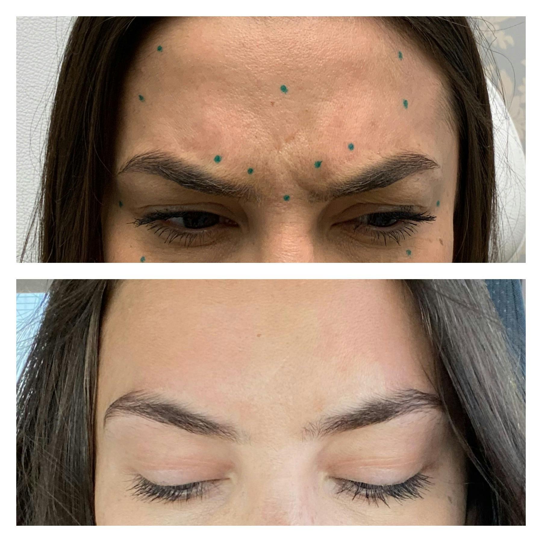 Wrinkle Relaxers Before & After Gallery - Patient 122270740 - Image 1