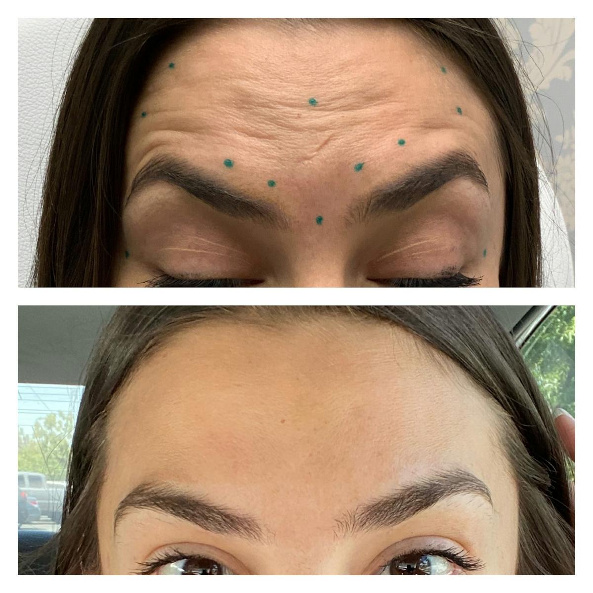 Wrinkle Relaxers Before & After Gallery - Patient 122270741 - Image 1