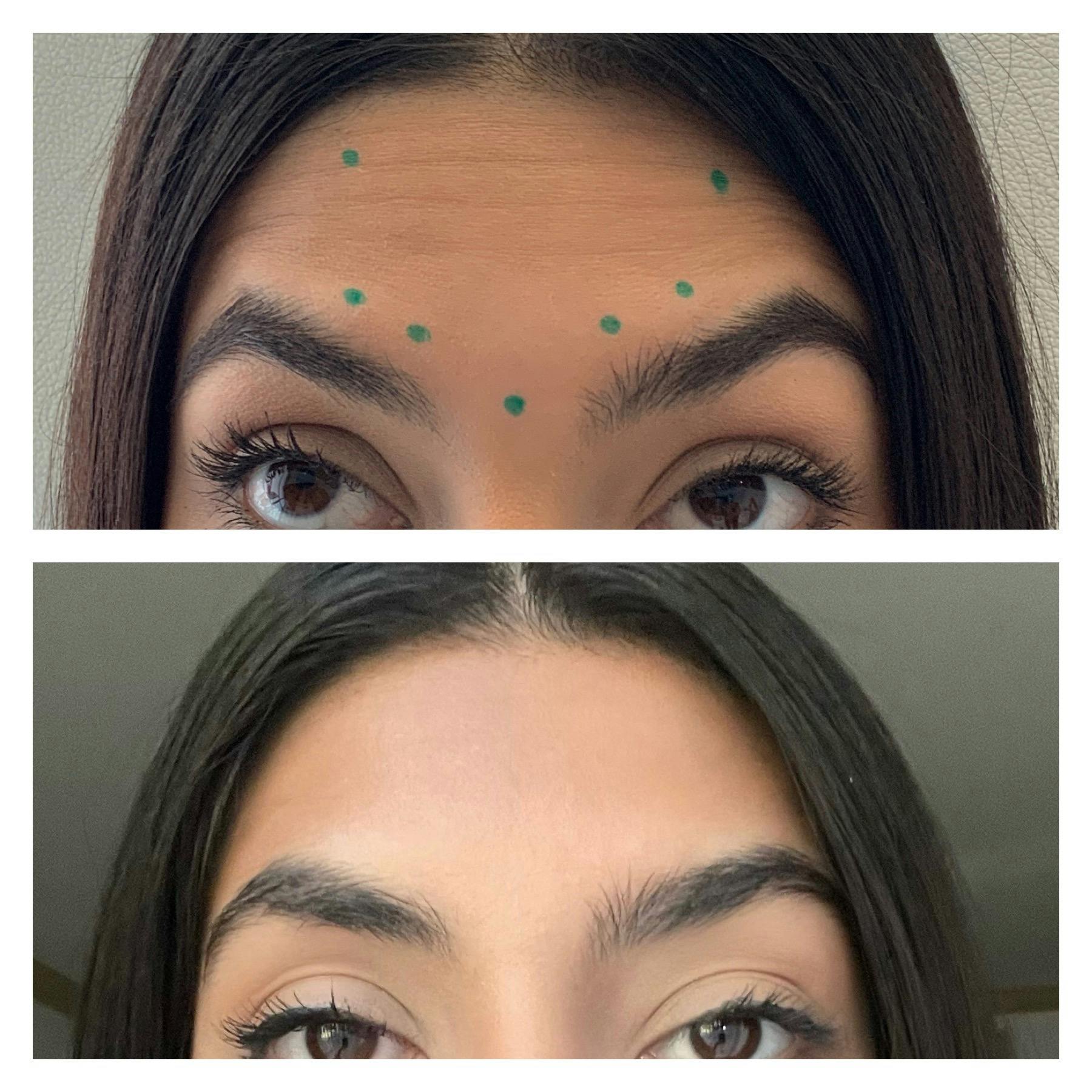 Wrinkle Relaxers Before & After Gallery - Patient 122270739 - Image 1