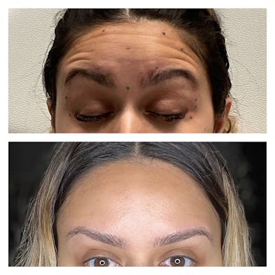 Wrinkle Relaxers Before & After Gallery - Patient 122270737 - Image 1