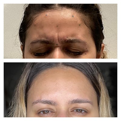 Wrinkle Relaxers Before & After Gallery - Patient 122270738 - Image 1