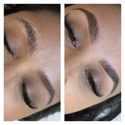 Brow Treatments Before & After Gallery - Patient 122270743 - Image 1