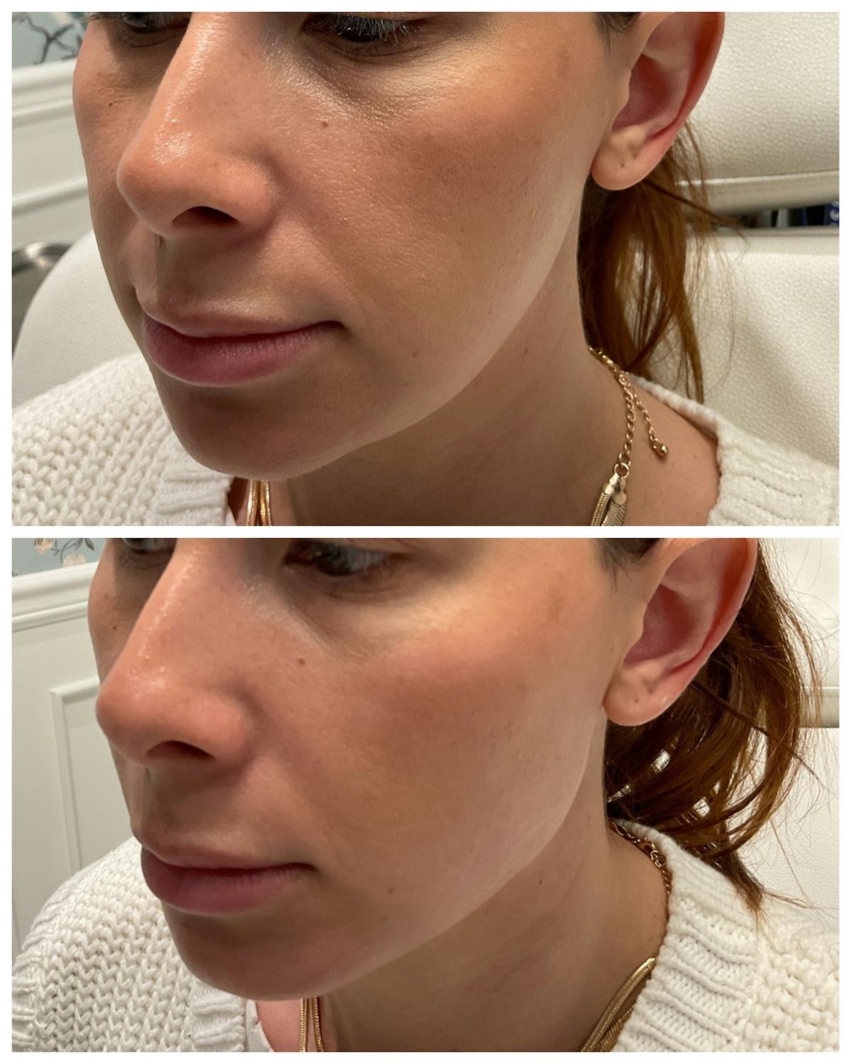 Dermal Fillers Before & After Gallery - Patient 122270860 - Image 1