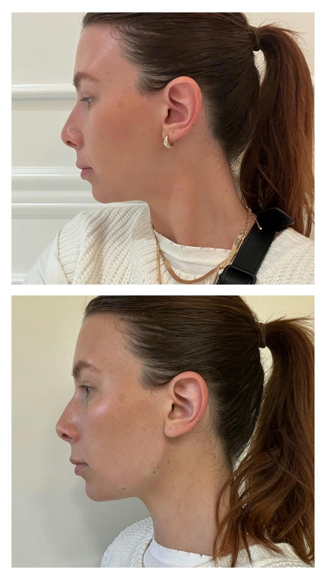 Dermal Fillers Before & After Gallery - Patient 122270860 - Image 2