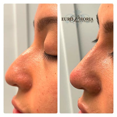 Non-Surgical Rhinoplasty Before & After Gallery - Patient 122582836 - Image 1