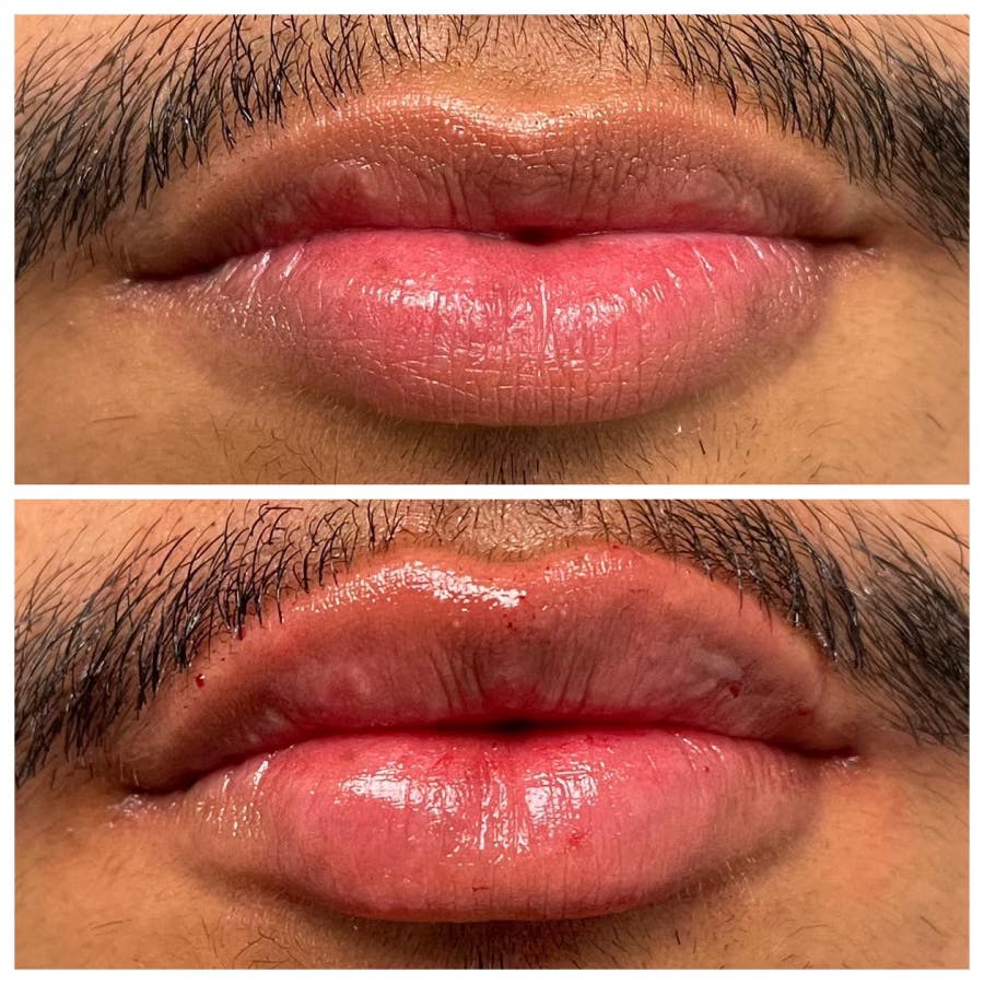 Full Pout® Before & After Gallery - Patient 122582845 - Image 1