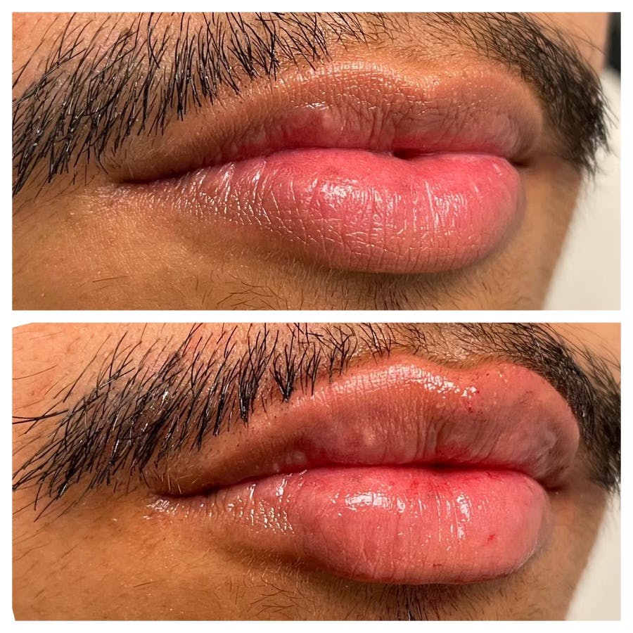 Full Pout® Before & After Gallery - Patient 122582845 - Image 2